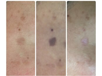 パーム(Palm)/シミケア