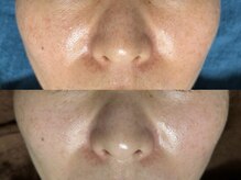 リボーン(REBORN)/光フェイシャル