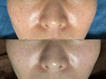 リボーン(REBORN)/光フェイシャル