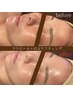 【韓国で話題/ツヤ肌ピーリング♪】ララピール+白玉リフティング¥11000→6900