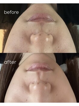 ヒミー(himee)/お肌のSOSはハーブピーリング