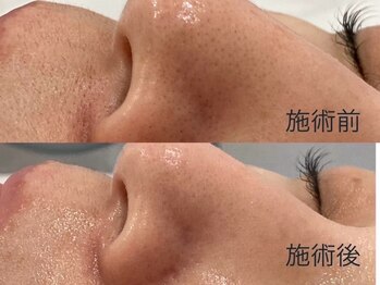 ルル 北仙台/お客様Before/After　毛穴