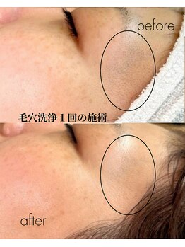 ナチュラル グロウ 木更津(NATURAL GLOW)/毛穴洗浄×シャネルアンプル