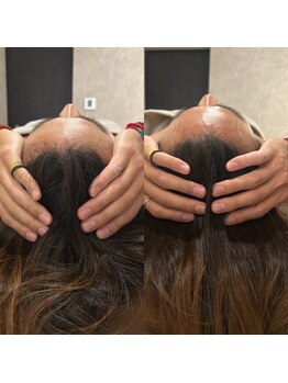 ルネアススパ 南青山(Lune’as Spa)/ドライヘッドスパ