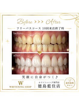 ホワイトニングショップ 徳島藍住店/Before After美白ホワイトニング