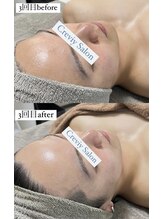 クレヴィー(Creviy)/メンズ陶肌トリートメント3回目