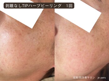 ジュパール(je pars)/TIPハーブピーリング