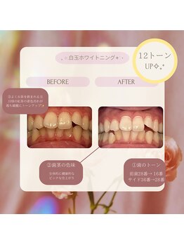 プラスビー 2号店(+b)/ホワイトニングビフォーアフター