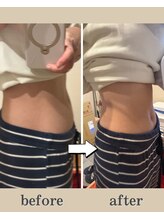 フローラ(FLORA)/施術ビフォーアフター