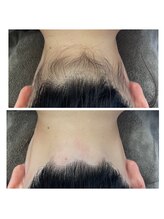 ミース 熊本店/うなじ矯正◆ビフォーアフター