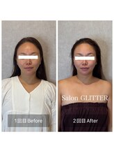 サロン グリッター 新宿(Salon GLITTER)/【小顔】ビフォーアフター