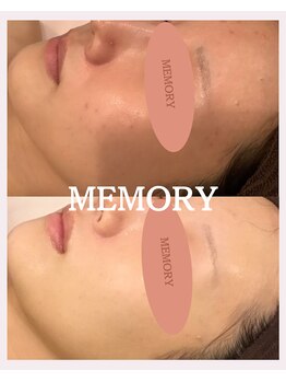 メモリー(MEMORY)/お悩みが改善し陶器肌へ♪