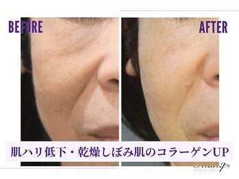 サンク(Thanq)/スマスアップ高周波でコラーゲン