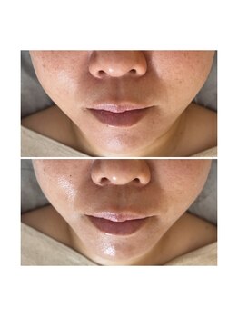 プリュムアイ フェイシャルホーム(prume eye.facial home)/ハーブピーリング