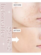 ピュアボディ(Pure Body)&nbsp;ビフォー アフター