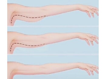 アウローラ 立川店(Aurora)の写真/憧れのはみ肉スッキリ二の腕へ！弛みスッキリで自信が持てる私に☆