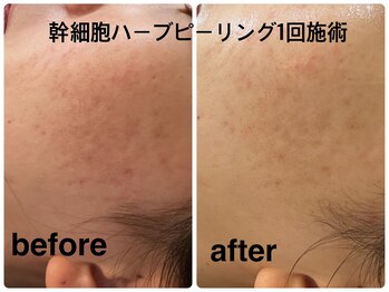 デューン 蕨店(Dune)/初めてのエステ【施術1回】