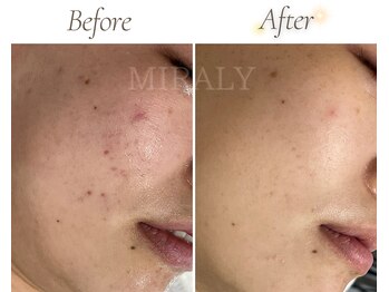 ミラリー(MIRALY)/敏感ニキビケア 4ヶ月(20代前半)