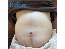 ウーマンビーヘルス(woman Be Health)/妊娠中の方　お腹の形　施術前