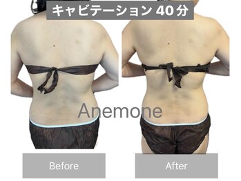 アネモネ/ダイエット/痩身/耳つぼ/腸活