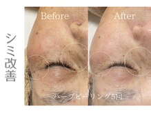 アニール(aniR)/ハーブピーリング/毛穴/毛穴/首