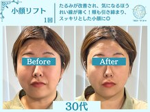 フローフシ∞/【小顔】切らない小顔リフト