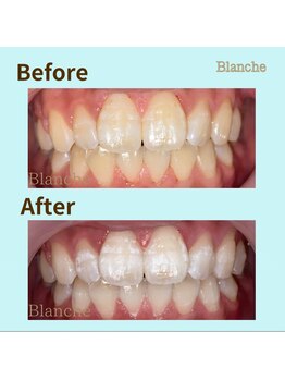 ホワイトニングサロン Blanche 心斎橋店/ビフォーアフター