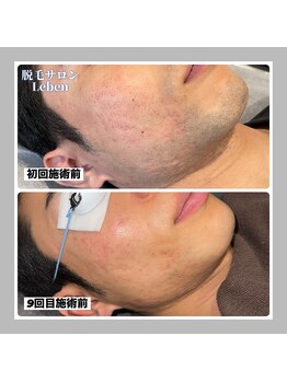 レーベン 戸畑店(Leben)/北九州ヒゲ脱毛