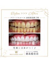 ホワイトニングショップ 徳島藍住店/Before After美白ホワイトニング