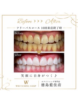 ホワイトニングショップ 徳島藍住店/Before After美白ホワイトニング