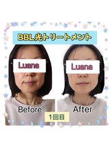 ルアナ(Luana)/BBL光トリートメント