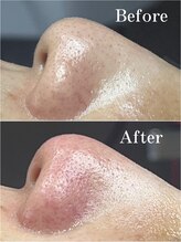 ティーツリー 名古屋 桜山(Tea Tree)/今日もお鼻の大掃除