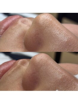 ルームエス 薬院(RoomS)/パーツワックス(鼻)