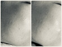 エフェクト 塚口店(effect)/Before After &nbsp;&nbsp;20代/1回目