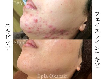 エピア 岡崎店(Epia)/フェイスラインニキビ