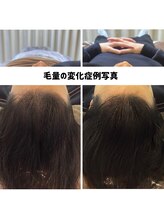 リジェ(Rege)/20代男性の方　施術＋ホームケア