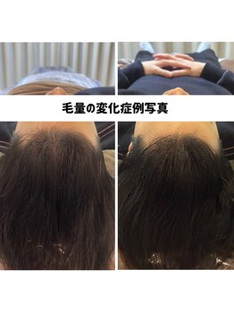 リジェ(Rege)/20代男性の方　施術＋ホームケア