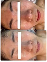 ソフィア わさだ店/セルマン肌質改善1回