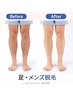 膝上や膝下の脱毛　メンズ脱毛　