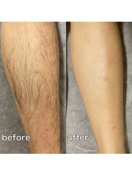 ブラジリアンワックス&光脱毛サロン　　　　　　No.A 恵比寿店【ナンバーエー】/"足ダブル脱毛"