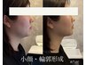 ≪イベント前にも◎≫小顔・脂肪分解REDSHOTフェイシャル80分¥14,000→