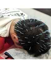 よつば鍼灸整骨院 春日院/頭皮鍼