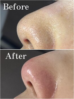 ティーツリー 名古屋 桜山(Tea Tree)/鼻がきれいだと