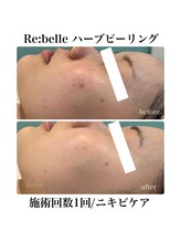 サラ/ハーブピーリング