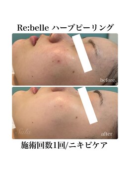 サラ/ハーブピーリング