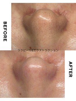 ジーンバイピエル 中野店(gene by PIEL)の写真/黒ずみ角栓ごっそり除去/毛穴エクストラクション&LDMでしっかり鎮静【中野/黒ずみ毛穴ケア】