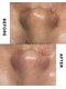 ジーンバイピエル 中野店(gene by PIEL)の写真/黒ずみ角栓ごっそり除去/毛穴エクストラクション&LDMでしっかり鎮静【中野/黒ずみ毛穴ケア】