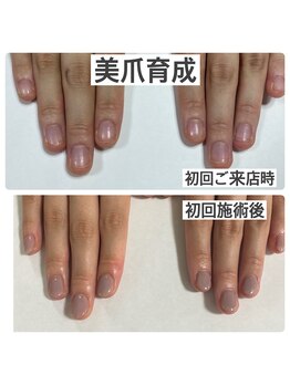 マニュコクーン(ManuCocoon)/爪育成 深爪 巻き爪 大阪市