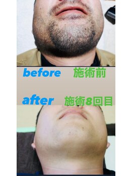 ゴッド(GOD)/ヒゲ脱毛before　after★