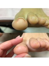 マニュコクーン(ManuCocoon)/爪育成　深爪　巻き爪　大阪市